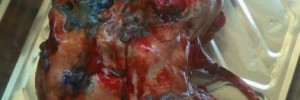 Polycystic kidney disease.