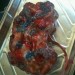 Polycystic kidney disease.